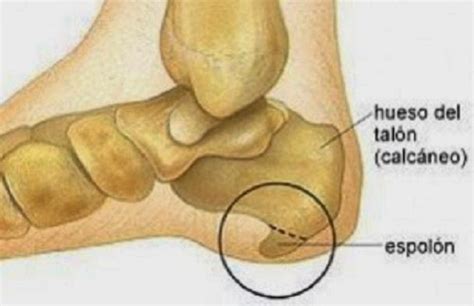 Abre Los Ojos: Espolón calcáneo: síntomas y tratamiento