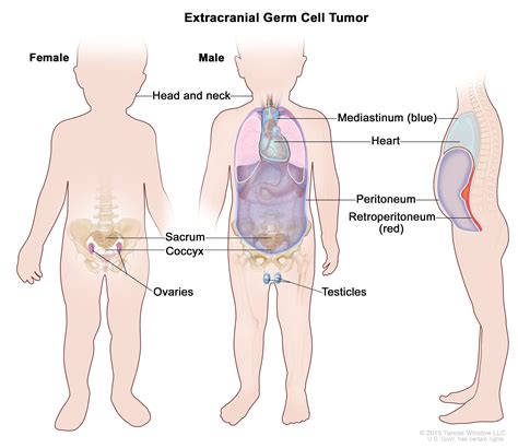 Extracranial Germ Cell Tumors | Vanderbilt-Ingram Cancer Center