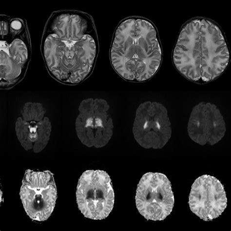 Kernicterus : MRI in a 15-day-old boy shows hyperintense globi pallidi ...