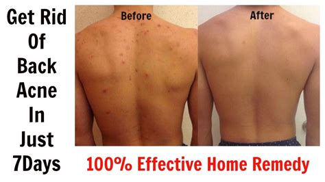 Get Rid Of Back Acne In Just 7 Days || 100% Effective Home Remedy - YouTube