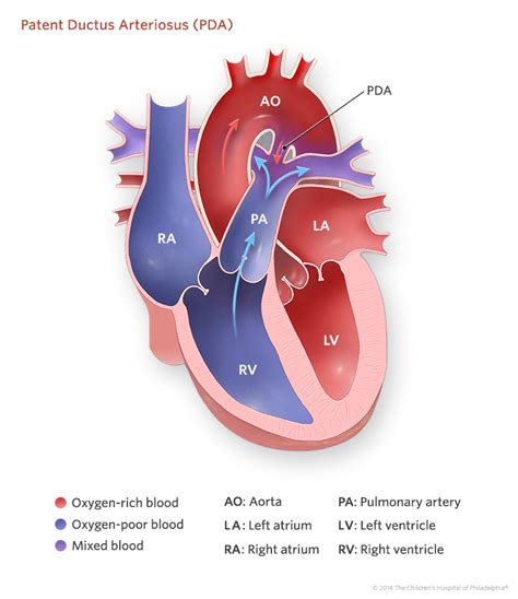 Patent Ductus Arteriosus Pda