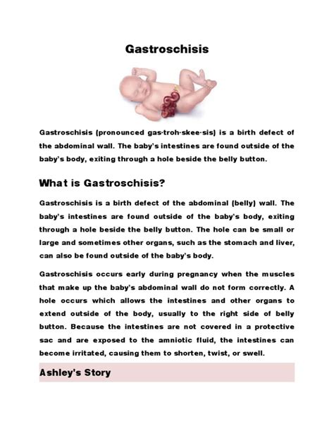 An In-Depth Look at Gastroschisis: Causes, Symptoms, Diagnosis and Treatment | PDF | Abdomen | Rtt