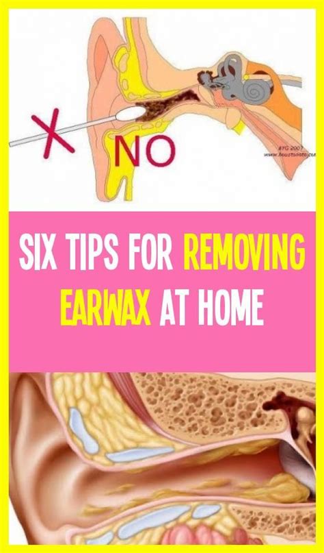 6 Tips For Earwax Removal Home #earcanal #innerear in 2020 | Ear wax, Natural lubricant, Tips