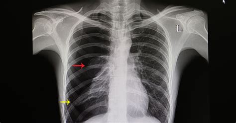 10 Causes, Symptoms, and Treatments: Pneumothorax - Facty Health