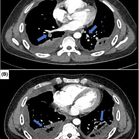 Chest X‐rays. (A) On presentation with COVID‐19 was nearly normal. (B ...