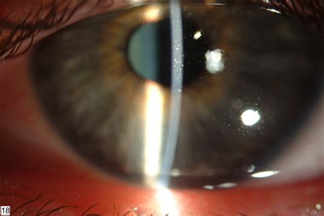 File:Thygeson's superficial punctate keratitis.jpg - Wikipedia, the ...