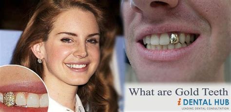 Benefits Of Permanent Gold Teeth | identalhub.com | Gold teeth, Permanent gold teeth, Teeth implants