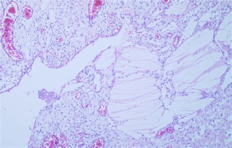 Mesenteric cyst wall with granulation tissue and cholesterol crystals ...