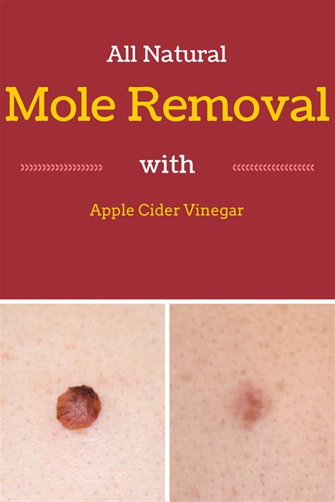 Apple Cider Vinegar Mole Removal Problems - All Are Here