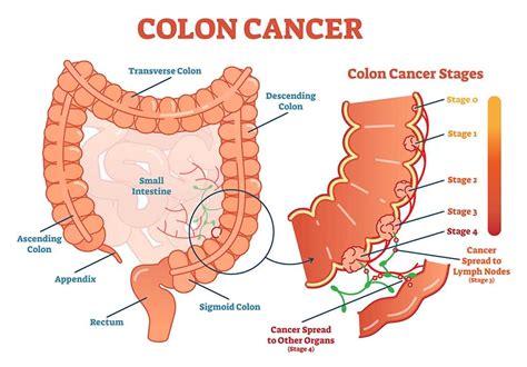 Colon Cancer; Stages, Symptoms, Causes and Screening