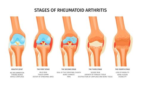 Free Vector | Realistic infographics showing four stages of rheumatoid ...