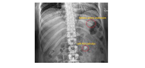 Imaging Case of the Week 147 Answer | Emergucate