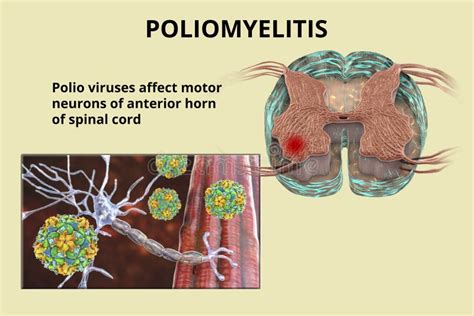 Polio Viruses Affecting Motor Neurons Stock Illustration - Illustration of human, poliovirus ...