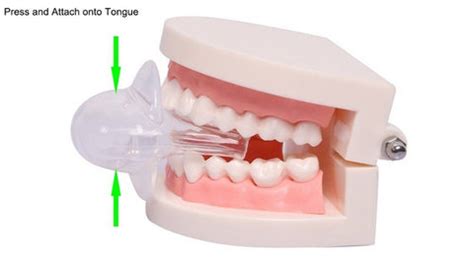 Apnea Tongue Stabilizing Device TSD – Wanda Supply