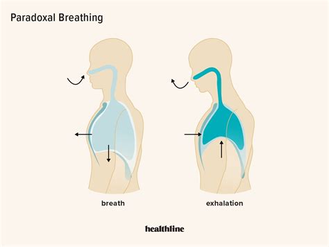 Paradoxical Breathing: Symptoms, Causes, and Treatments