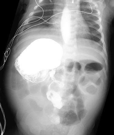 Corkscrew sign | Radiology Reference Article | Radiopaedia.org ...