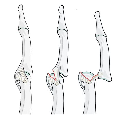 Volar Plate Injuries (Jammed Finger) Proximal Phalangeal Joint fractures – Lothian Virtual Hand ...