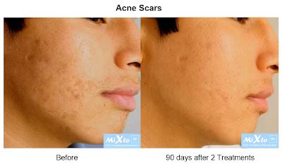 Lasering MiXto CO2 Fractional Laser - Join The Fractional Revolution: Acne Treatment Video for ...