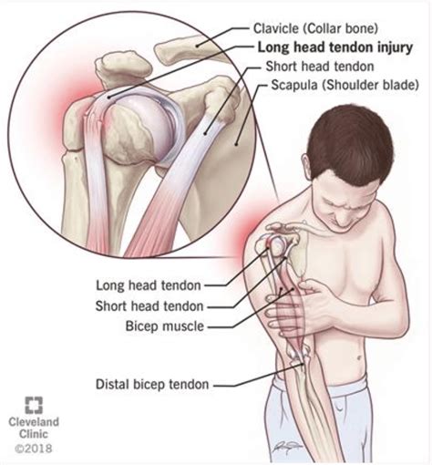 Long Head of the Biceps Tendinopathy - The Climbing Doctor