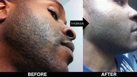 folliculitis from shaving - pictures, photos