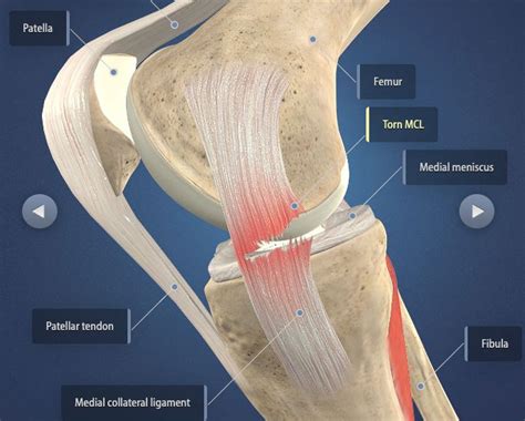 The Do's and Don'ts After ACL & MCL Tears & Surgery | Heiden Orthopedics