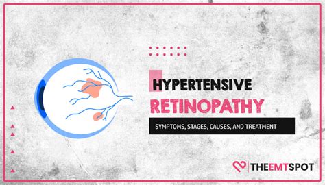 Hypertensive Retinopathy: Symptoms, Stages, Causes, And Treatment | TheEMTSpot