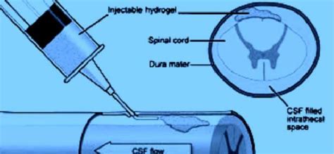 A minimally-invasive intrathecal drug delivery system for spinal cord... | Download Scientific ...