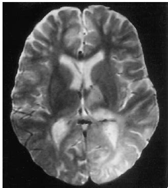 A 9-year-old boy with a 5-month history of SSPE, clinical stage G:IIA.... | Download Scientific ...