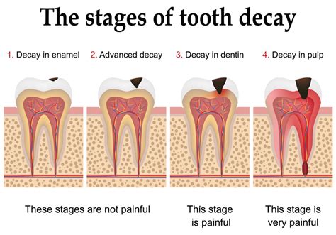 Is it Possible to Reverse Tooth Decay? | Governor’s Park Dental Group