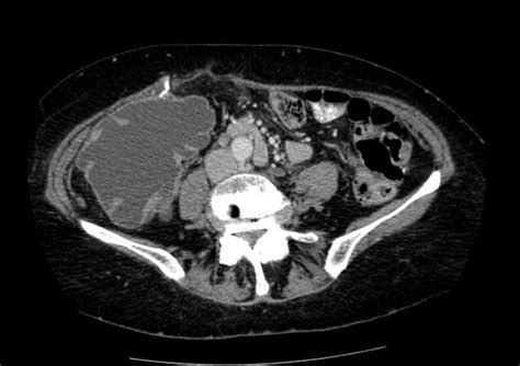 Ileal conduit urinary diversion - wikidoc