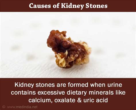 What are the Causes of Kidney Stones?