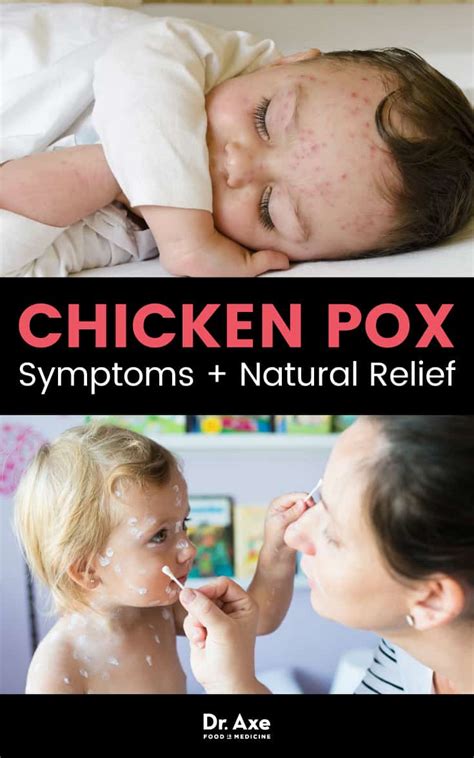 Chicken Pox Symptoms + How to Find Natural Relief - Dr. Axe