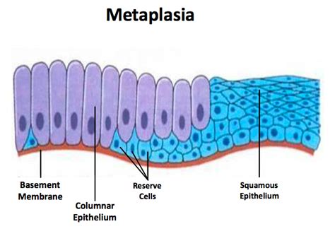 O que é Metaplasia?