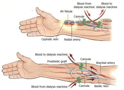 Dialysis Fistula Diagram