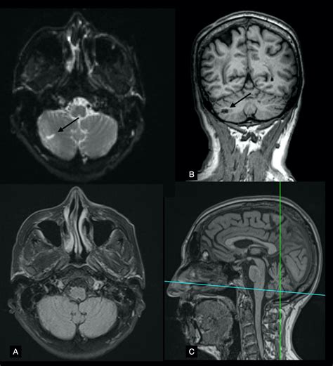 Cureus | Brainstem Stroke Presenting as Wake-Up Diplopia in a Patient With an Incomplete Circle ...