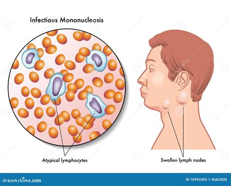 Infectious Mononucleosis Cartoon Vector | CartoonDealer.com #55924189