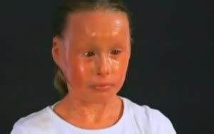 Harlequin Ichthyosis – Pictures, Survivors, Causes, Treatment