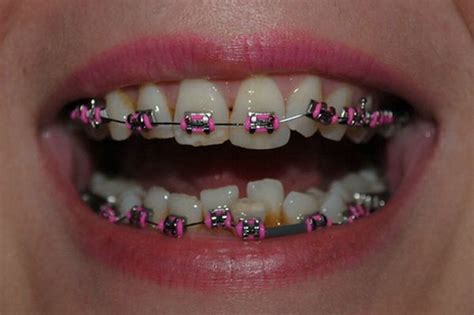 Pink Braces For Teeth - Teeth Braces Ideas | Pink braces, Teeth braces, Braces