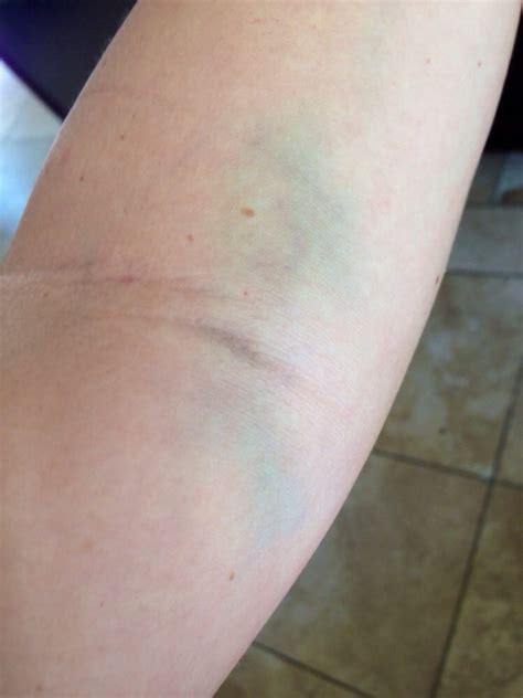 Bruising After Blood Draw : Bruise After Drawn Blood On Arm Stock Photo ...