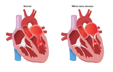 Mitral Stenosis | Concise Medical Knowledge