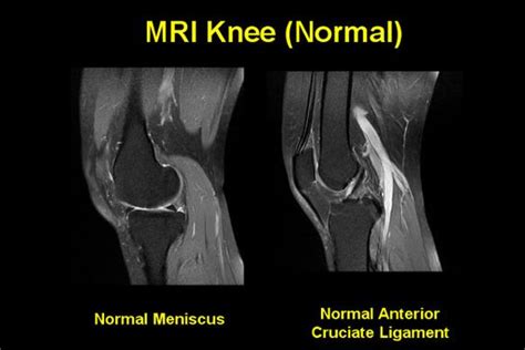 MRI knee - Google Search | Anatomy - Imaging | Knee mri, Anatomy images ...