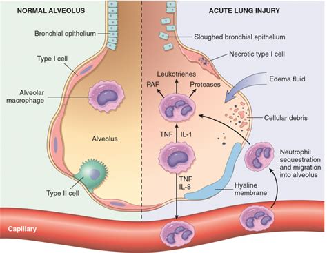 77. Congenital anomalies of the lungs, atelectasis, acute lung injury – greek.doctor