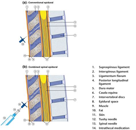 Epidural analgesia in labor: A narrative review - Halliday - 2022 - International Journal of ...