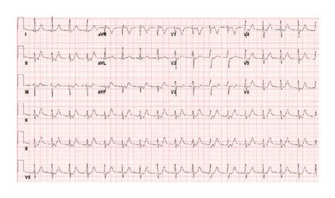 Initial EKG demonstrating accelerated junctional rhythm at 99 ...