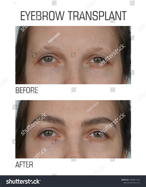 Alopecia Close Female Eyes Before After Stock Photo 1959811324 ...