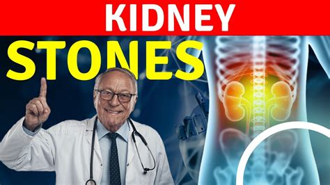 The Shocking Truth About Kidney Stones Revealed! || kidney stones symptoms - YouTube