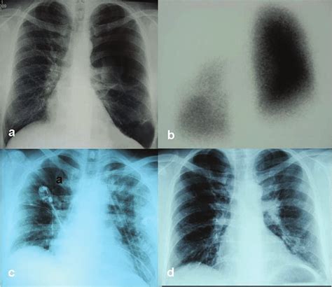 Figure1: Hyperinflation of the left lung on chest X-ray (a), there were ...