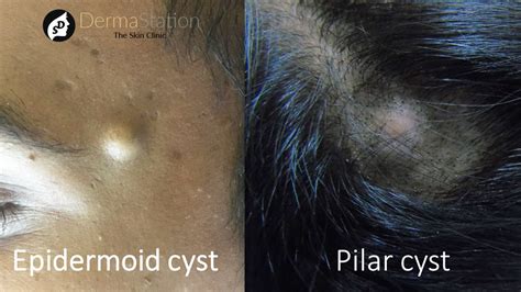 Epidermoid and Pilar Cysts