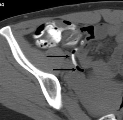 CT Evaluation of Appendicitis and Its Complications: Imaging Techniques and Key Diagnostic ...