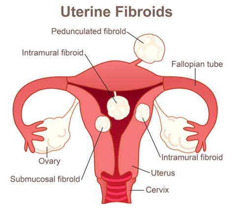 A Quick Primer for Understanding Ovarian Cysts & Uterine Fibroids | HealthToday